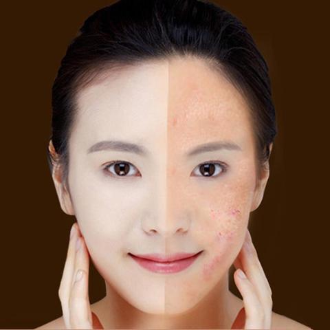 Blue Light Therapy Acne Laser Pen Soft Scar Wrinkle Removal Treatment Device Skin Care Beauty Equipment - Image 7